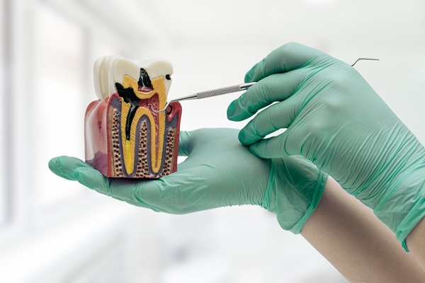 A Snapshot Of The Four Types Of Dental Bridges