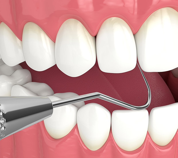 Douglasville Interactive Periodontal Probing