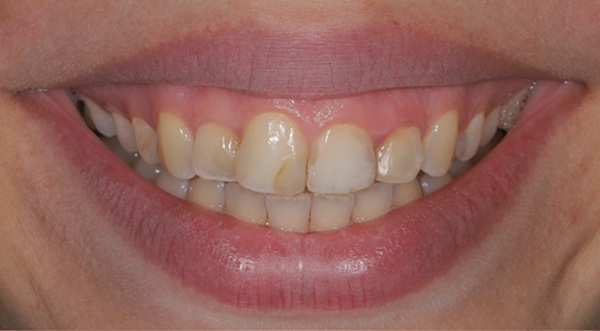 The Importance Of Working With The Right Dentist For A Smile Makeover